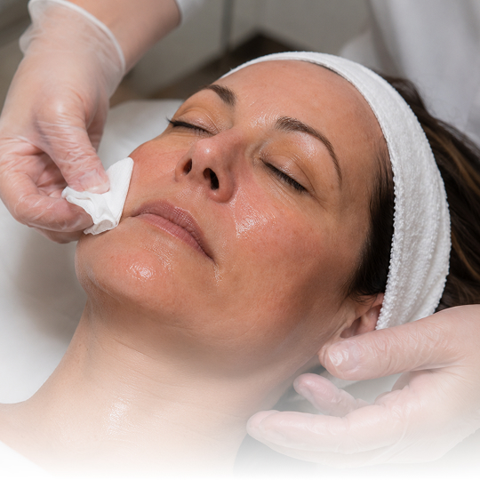 Chemical Peels Image